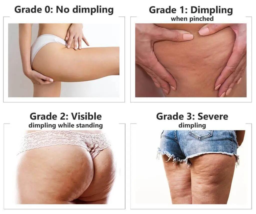 Representation of the stages of cellulite development Hassocks